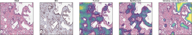 Figure 4 for Unsupervised Prostate Cancer Detection on H&E using Convolutional Adversarial Autoencoders