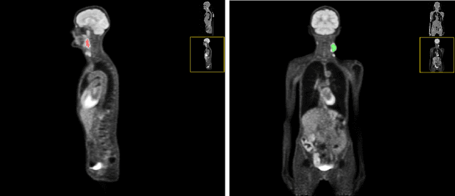 Figure 2 for Automated head and neck tumor segmentation from 3D PET/CT