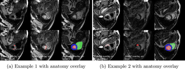 Figure 1 for Max-Fusion U-Net for Multi-Modal Pathology Segmentation with Attention and Dynamic Resampling