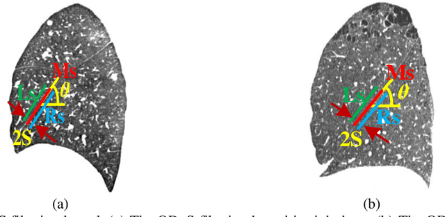 Figure 3 for Pulmonary Fissure Segmentation in CT Images Based on ODoS Filter and Shape Features