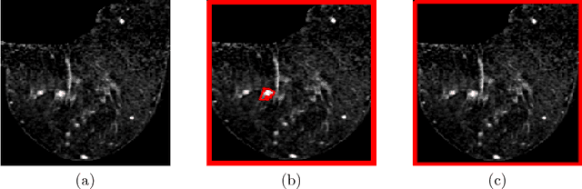 Figure 1 for Pre and Post-hoc Diagnosis and Interpretation of Malignancy from Breast DCE-MRI