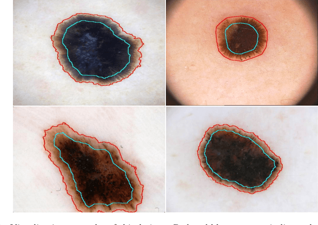 Figure 1 for Knowledge-aware Deep Framework for Collaborative Skin Lesion Segmentation and Melanoma Recognition