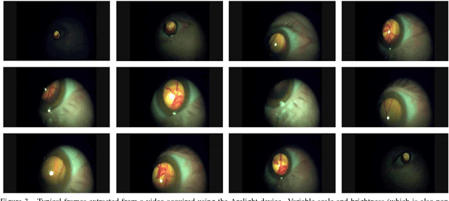 Figure 3 for Synthesising Wider Field Images from Narrow-Field Retinal Video Acquired Using a Low-Cost Direct Ophthalmoscope (Arclight) Attached to a Smartphone
