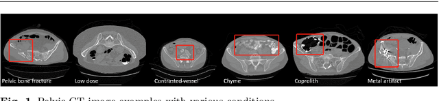 Figure 1 for Deep Learning to Segment Pelvic Bones: Large-scale CT Datasets and Baseline Models