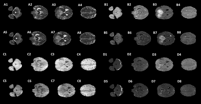 Figure 2 for Improvement of Multiparametric MR Image Segmentation by Augmenting the Data with Generative Adversarial Networks for Glioma Patients
