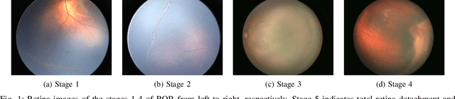 Figure 1 for Retinopathy of Prematurity Stage Diagnosis Using Object Segmentation and Convolutional Neural Networks