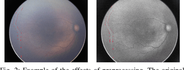 Figure 2 for Retinopathy of Prematurity Stage Diagnosis Using Object Segmentation and Convolutional Neural Networks
