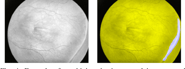 Figure 4 for Retinopathy of Prematurity Stage Diagnosis Using Object Segmentation and Convolutional Neural Networks
