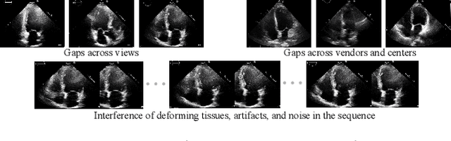 Figure 1 for Recurrent Aggregation Learning for Multi-View Echocardiographic Sequences Segmentation