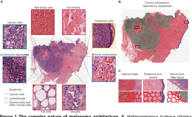 Figure 1 for Capturing global spatial context for accurate cell classification in skin cancer histology