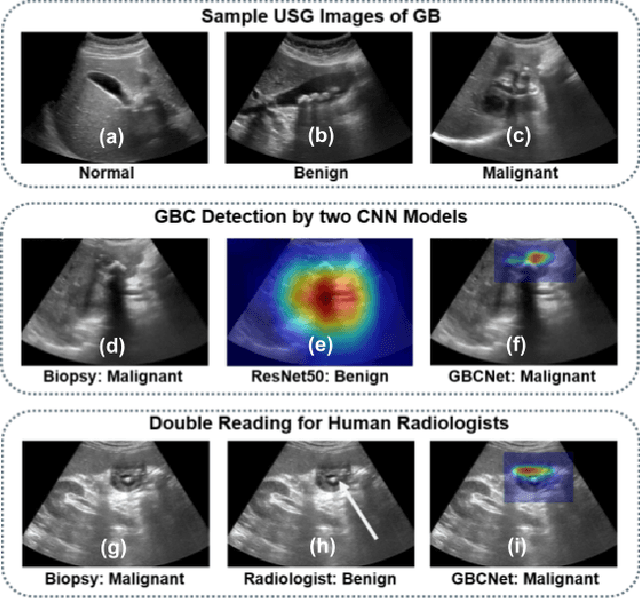 Figure 1 for Surpassing the Human Accuracy: Detecting Gallbladder Cancer from USG Images with Curriculum Learning