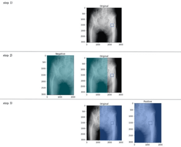 Figure 2 for A Computer-Aided Diagnosis System Using Artificial Intelligence for Hip Fractures Significantly Improves the Diagnostic Rate of Residents. -Multi-Institutional Joint Development Research-