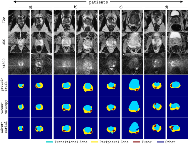 Figure 3 for Adversarial Networks for the Detection of Aggressive Prostate Cancer