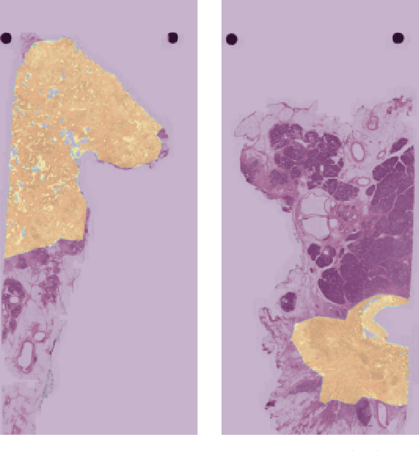 Figure 1 for Automatic tumour segmentation in H&E-stained whole-slide images of the pancreas