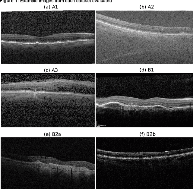 Figure 2 for Disease classification of macular Optical Coherence Tomography scans using deep learning software: validation on independent, multi-centre data