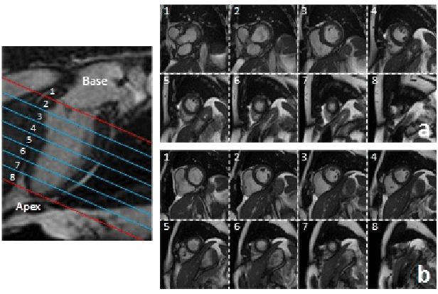 Figure 1 for Automatic Assessment of Full Left Ventricular Coverage in Cardiac Cine Magnetic Resonance Imaging with Fisher-Discriminative 3D CNN