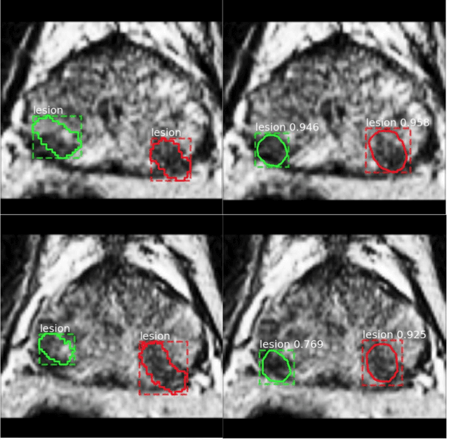 Figure 4 for Segmentation of the Prostatic Gland and the Intraprostatic Lesions on Multiparametic MRI Using Mask-RCNN