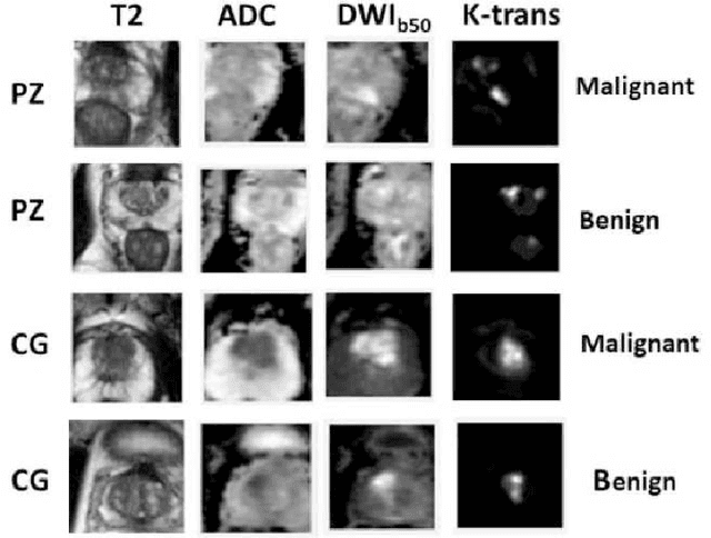 Figure 1 for Prostate Cancer Malignancy Detection and localization from mpMRI using auto-Deep Learning: One Step Closer to Clinical Utilization