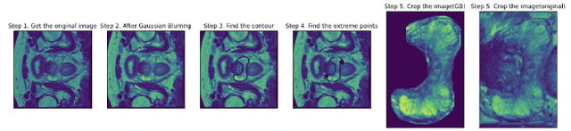 Figure 2 for Prostate Cancer Malignancy Detection and localization from mpMRI using auto-Deep Learning: One Step Closer to Clinical Utilization