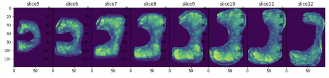Figure 3 for Prostate Cancer Malignancy Detection and localization from mpMRI using auto-Deep Learning: One Step Closer to Clinical Utilization