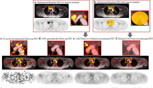 Figure 2 for Masked Co-attentional Transformer reconstructs 100x ultra-fast/low-dose whole-body PET from longitudinal images and anatomically guided MRI