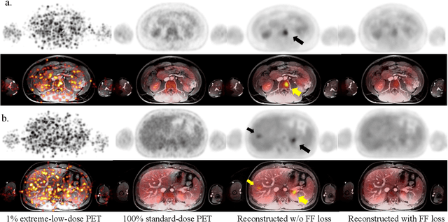 Figure 3 for Masked Co-attentional Transformer reconstructs 100x ultra-fast/low-dose whole-body PET from longitudinal images and anatomically guided MRI
