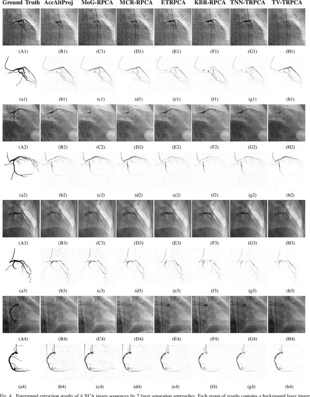 Figure 4 for Robust Implementation of Foreground Extraction and Vessel Segmentation for X-ray Coronary Angiography Image Sequence