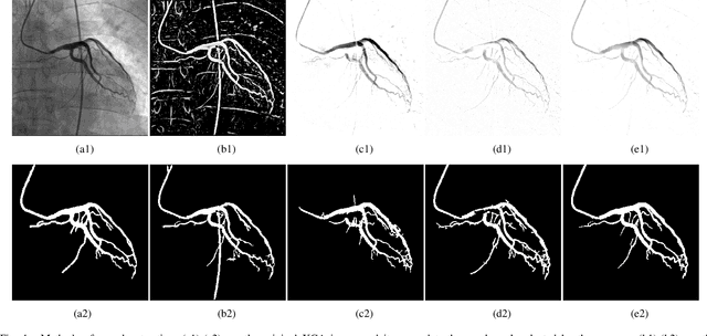 Figure 1 for Robust Implementation of Foreground Extraction and Vessel Segmentation for X-ray Coronary Angiography Image Sequence