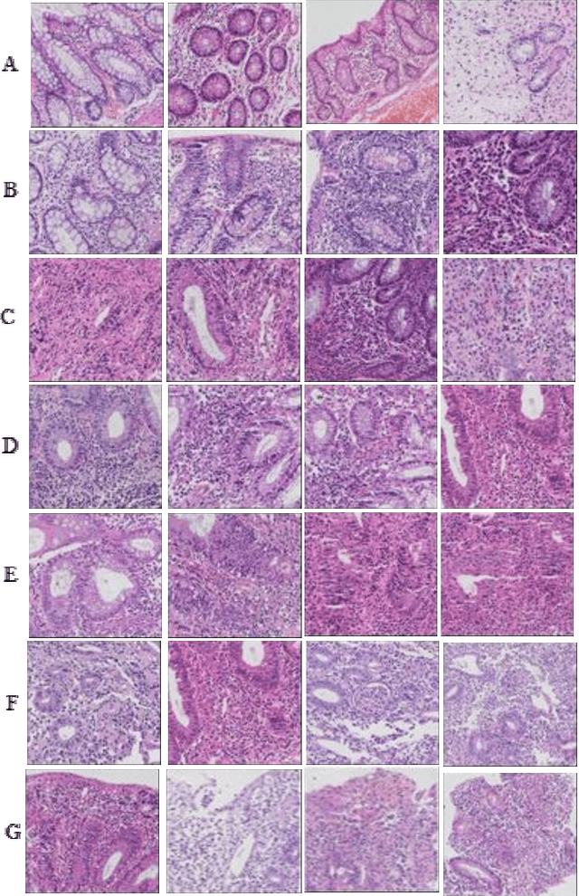 Figure 1 for Neural Network-Based Histologic Remission Prediction In Ulcerative Colitis