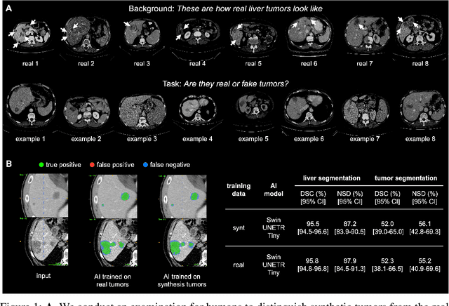 Figure 1 for Synthetic Tumors Make AI Segment Tumors Better