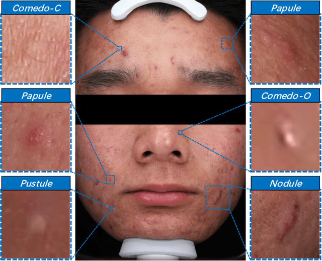 Figure 1 for Towards Accurate Acne Detection via Decoupled Sequential Detection Head