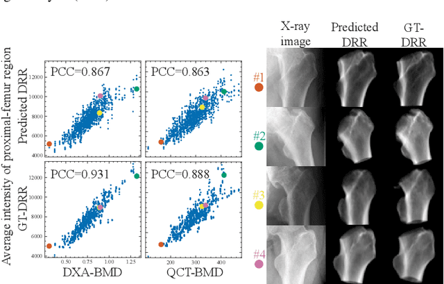 Figure 1 for Bone mineral density estimation from a plain X-ray image by learning decomposition into projections of bone-segmented computed tomography