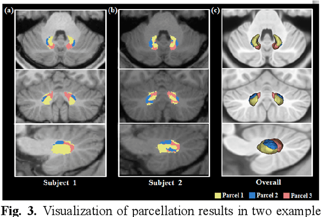 Figure 4 for Tractography-Based Parcellation of Cerebellar Dentate Nuclei via a Deep Nonnegative Matrix Factorization Clustering Method