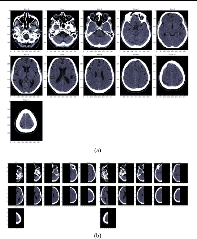 Figure 1 for Development of a Deep Learning Method to Identify Acute Ischemic Stroke Lesions on Brain CT