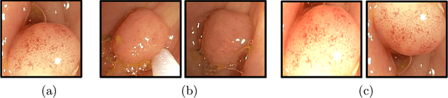 Figure 1 for Self-Supervised Polyp Re-Identification in Colonoscopy