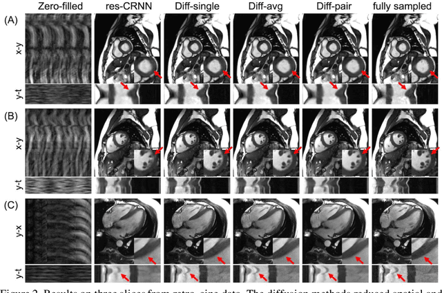 Figure 3 for Spatiotemporal Diffusion Model with Paired Sampling for Accelerated Cardiac Cine MRI