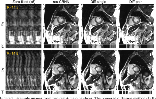 Figure 4 for Spatiotemporal Diffusion Model with Paired Sampling for Accelerated Cardiac Cine MRI