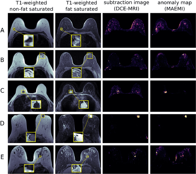 Figure 2 for 3D Masked Autoencoders with Application to Anomaly Detection in Non-Contrast Enhanced Breast MRI
