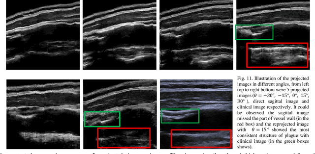 Figure 3 for Automatic Diagnosis of Carotid Atherosclerosis Using a Portable Freehand 3D Ultrasound Imaging System