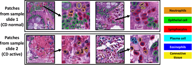 Figure 1 for Cell Spatial Analysis in Crohn's Disease: Unveiling Local Cell Arrangement Pattern with Graph-based Signatures