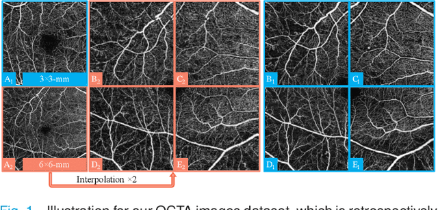 Figure 1 for Unpaired Optical Coherence Tomography Angiography Image Super-Resolution via Frequency-Aware Inverse-Consistency GAN