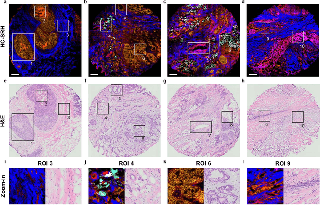 Figure 4 for High-content stimulated Raman histology of human breast cancer