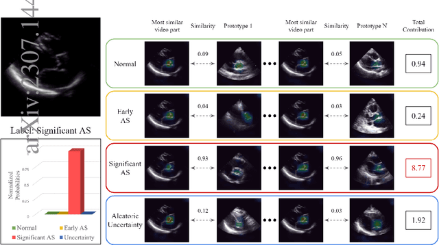 Figure 1 for ProtoASNet: Dynamic Prototypes for Inherently Interpretable and Uncertainty-Aware Aortic Stenosis Classification in Echocardiography