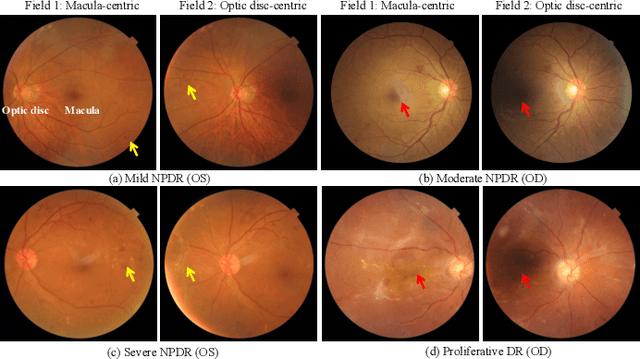 Figure 1 for Cross-Field Transformer for Diabetic Retinopathy Grading on Two-field Fundus Images