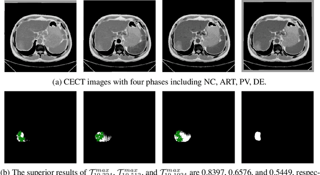 Figure 2 for When SAM Meets Medical Images: An Investigation of Segment Anything Model (SAM) on Multi-phase Liver Tumor Segmentation