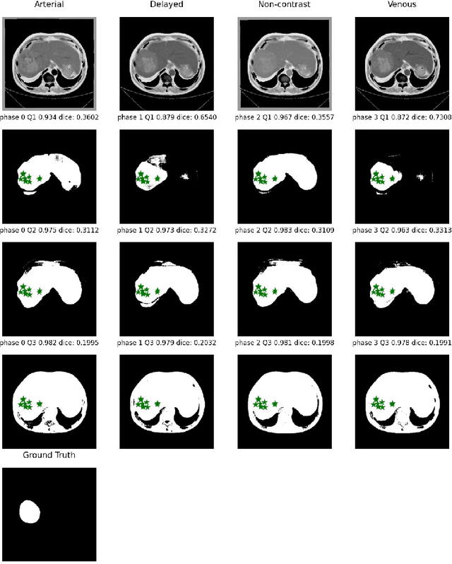Figure 4 for When SAM Meets Medical Images: An Investigation of Segment Anything Model (SAM) on Multi-phase Liver Tumor Segmentation