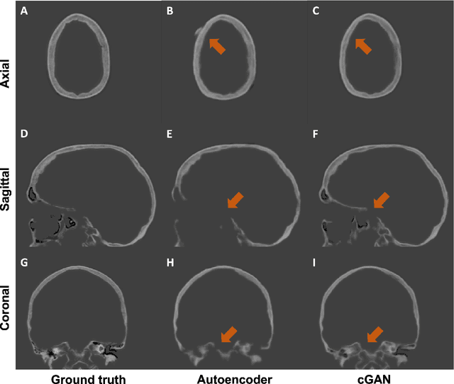 Figure 3 for Evaluation of Synthetically Generated CT for use in Transcranial Focused Ultrasound Procedures