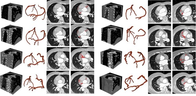 Figure 2 for ImageCAS: A Large-Scale Dataset and Benchmark for Coronary Artery Segmentation based on Computed Tomography Angiography Images