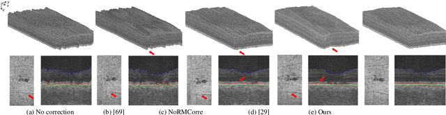 Figure 4 for Simultaneous Alignment and Surface Regression Using Hybrid 2D-3D Networks for 3D Coherent Layer Segmentation of Retinal OCT Images with Full and Sparse Annotations