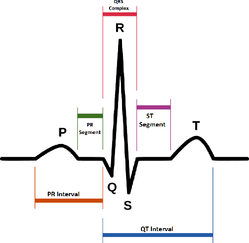 Figure 1 for Machine Learning-Based Automatic Cardiovascular Disease Diagnosis Using Two ECG Leads